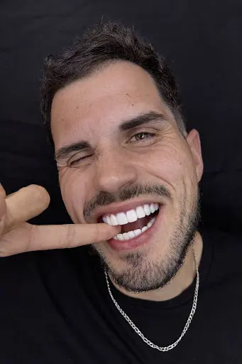 Facetas em Resina - Dr. Thiago Fonseca